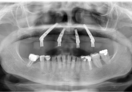 fogászati röntgen